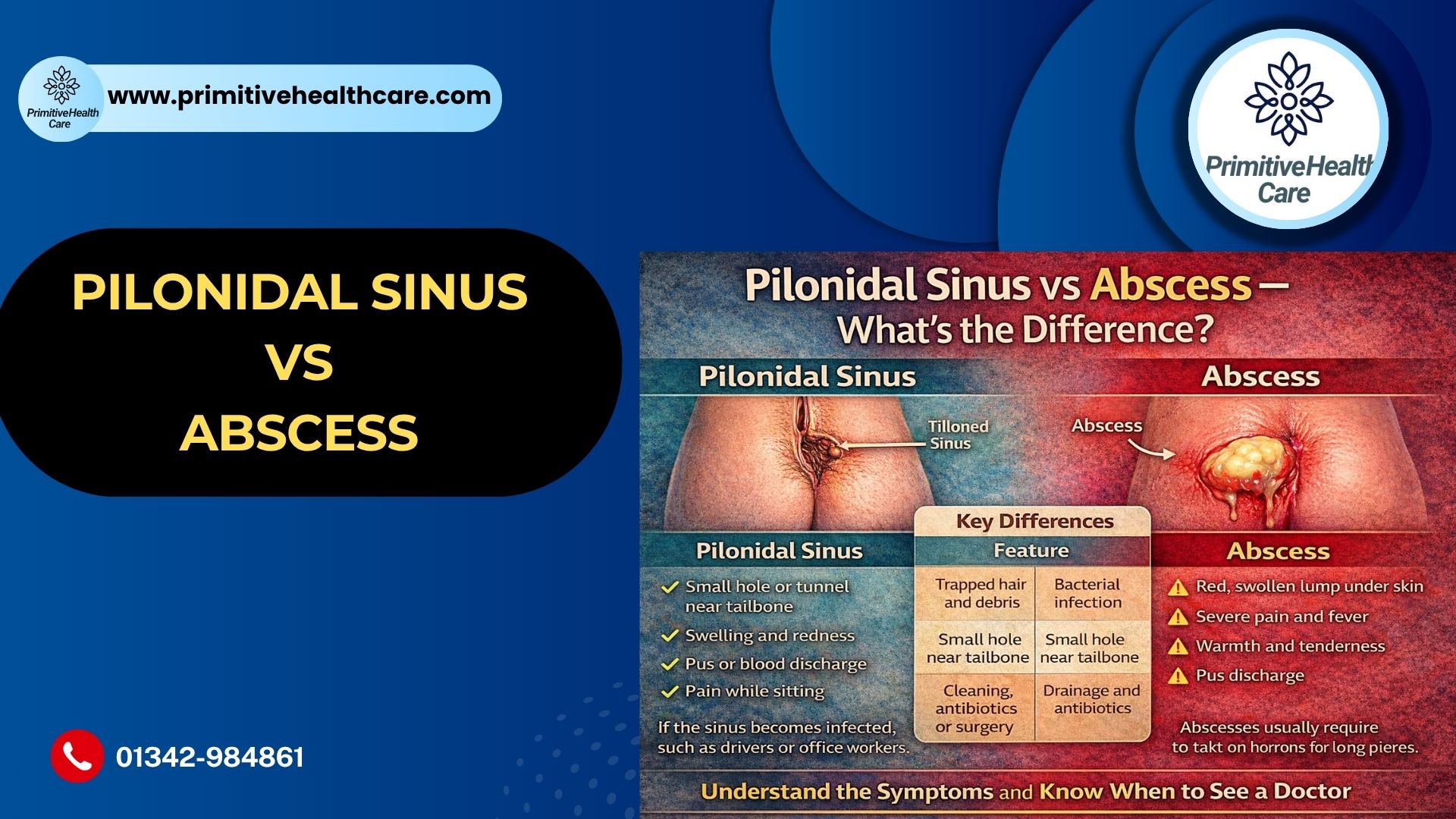 Pilonidal Sinus vs Abscess Difference